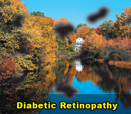 Diabetic-Retinopathy