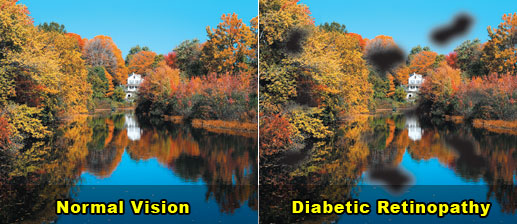 Diabetic-Retinopathy3