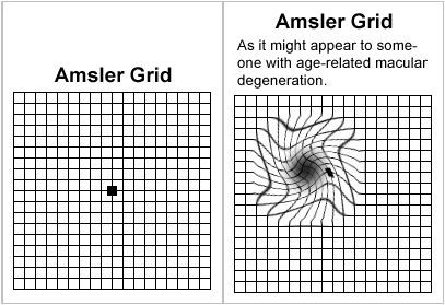 Macular Degeneration Eye Chart