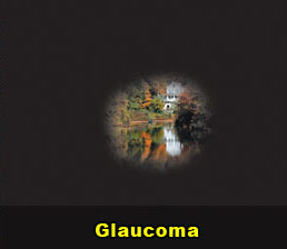 glaucoma