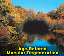 macular-degeneration