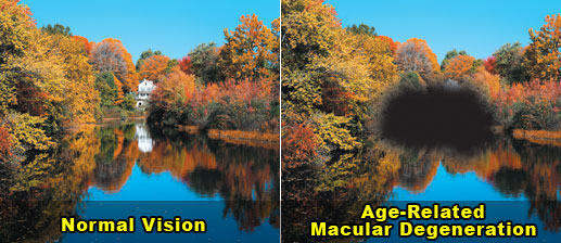 macular-degeneration3